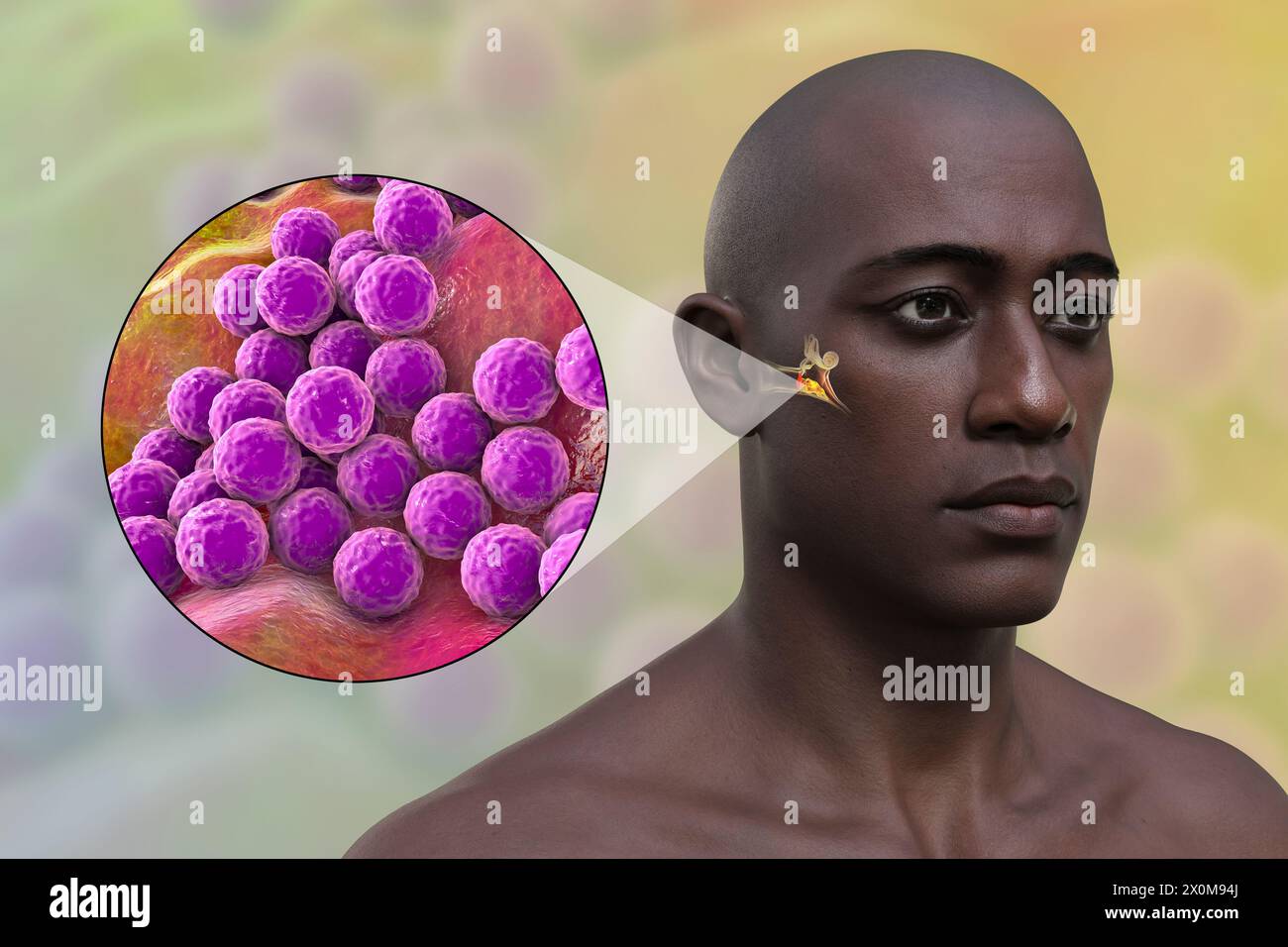 3D-Illustration eines Mannes mit einer bakteriellen Mittelohrinfektion (Otitis Media) und einer Nahaufnahme des verursachenden Bakteriums Staphylococcus aureus. Zu den Symptomen gehören Entzündungen, Flüssigkeitsansammlungen und Schmerzen im Ohr. Stockfoto