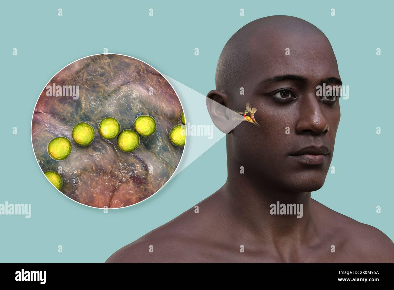 3D-Darstellung eines Mannes mit einer bakteriellen Mittelohrinfektion (Otitis Media) und einer Nahaufnahme der verursachenden Bakterien. Zu den Symptomen gehören Entzündungen, Flüssigkeitsansammlungen und Schmerzen im Ohr. Stockfoto