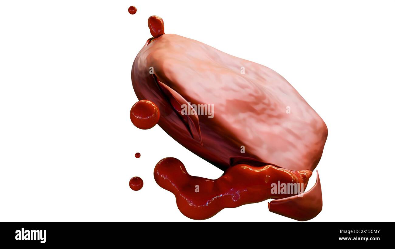3d Rendering der Hämolyse, ist der Prozess der roten Blutkörperchen zerbrechen und geben ihren Inhalt in die umgebende Flüssigkeit Stockfoto
