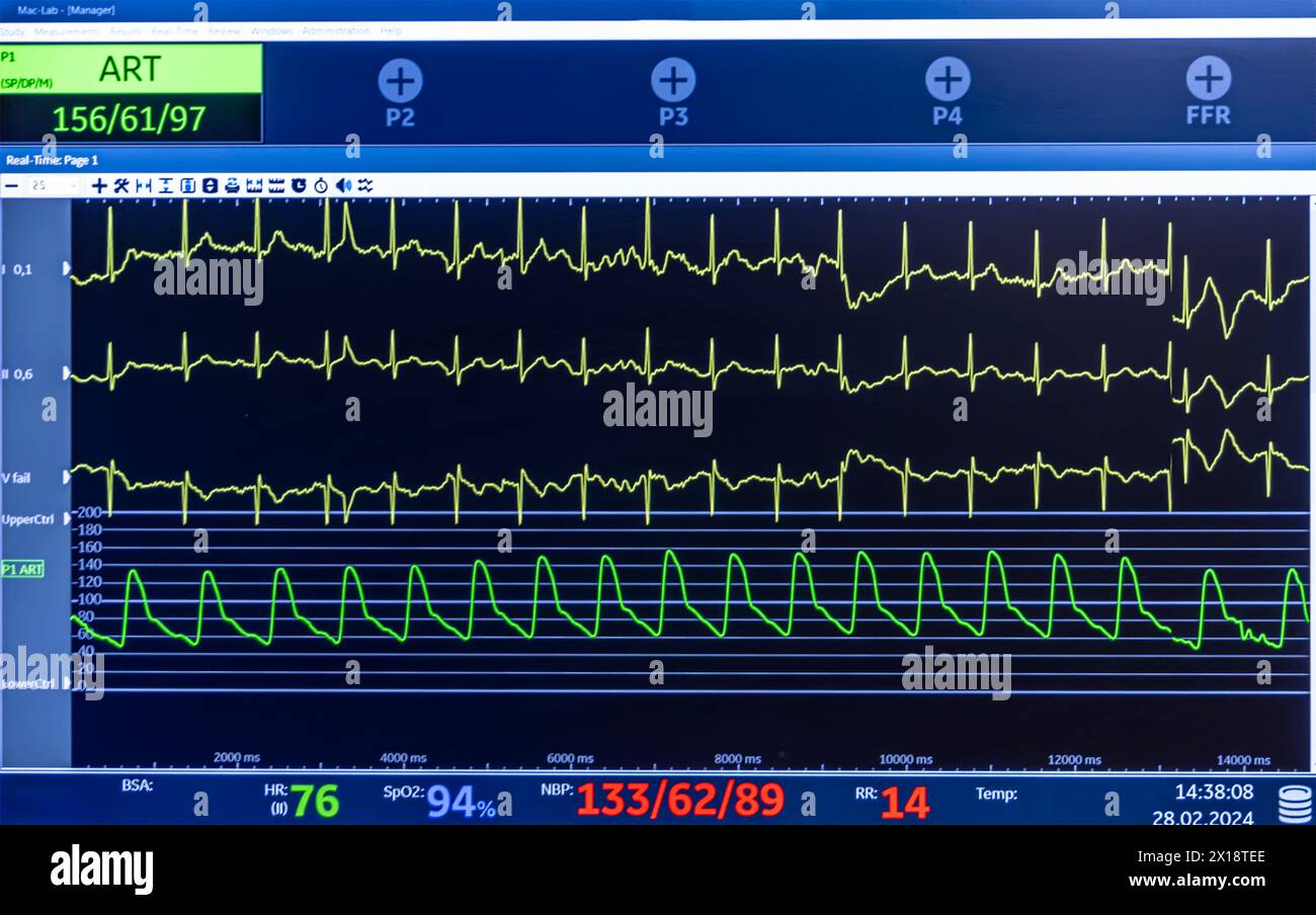 Denizli, Türkei - 28. Februar 2024; Monitor mit Vitalparametern und EKG-Daten des Patienten während der Operation im OP im Krankenhaus. Zeigt p Stockfoto