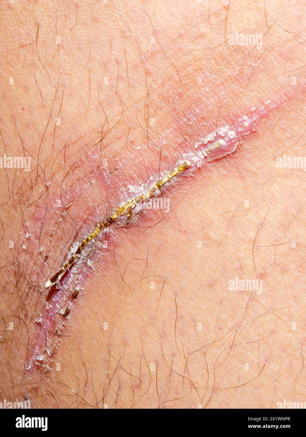 Nahaufnahme einer verletzten Haut, die nach dem Schaden ihren Heilungsprozess durchläuft. Stockfoto