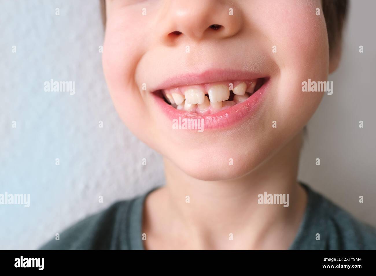 Kleines Kind, Kind 7-8 Jahre alt sitzt mit offenem Mund, Zähne Nahaufnahme, Untersuchung des Backenzahns durch einen Zahnarzt, Konzept der Zahnbehandlung, Bisskontrolle Stockfoto