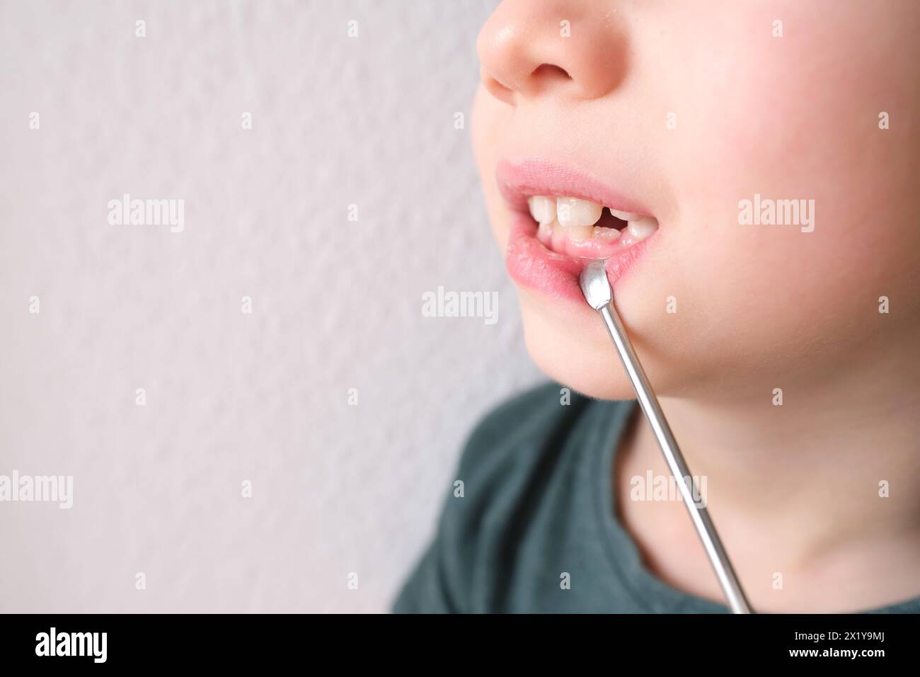 Kleinkind, Kind 7-8 Jahre alt sitzt mit offenem Mund, Zähne Nahaufnahme, Untersuchung des Backenzahns durch einen Zahnarzt, Konzept der Zahnbehandlung, Bisskontrolle Stockfoto