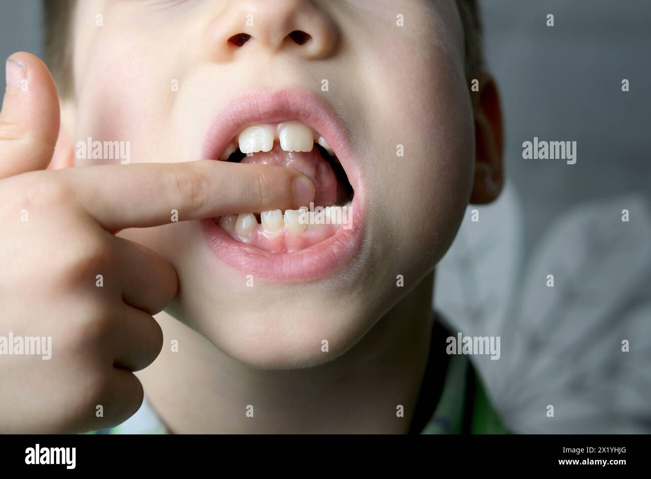 Mundhöhle eines kleinen Patienten, Länge des Frenums der Zunge, Junge, Kind führt Artikulationsübungen für Mund, Konzept der Sprachstörungen, korrekt Stockfoto