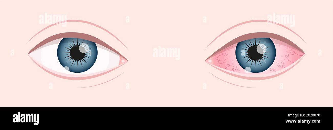 Gesundes und krankes menschliches Sehorgan. Trockenes Auge-Syndrom. Entzündeter Augapfel mit Reizung und roter Bindehaut. Symptome von Keratitis, Blepharitis, Konjunktivitis oder Uveitis. Illustration der Vektorabwicklung. Stock Vektor