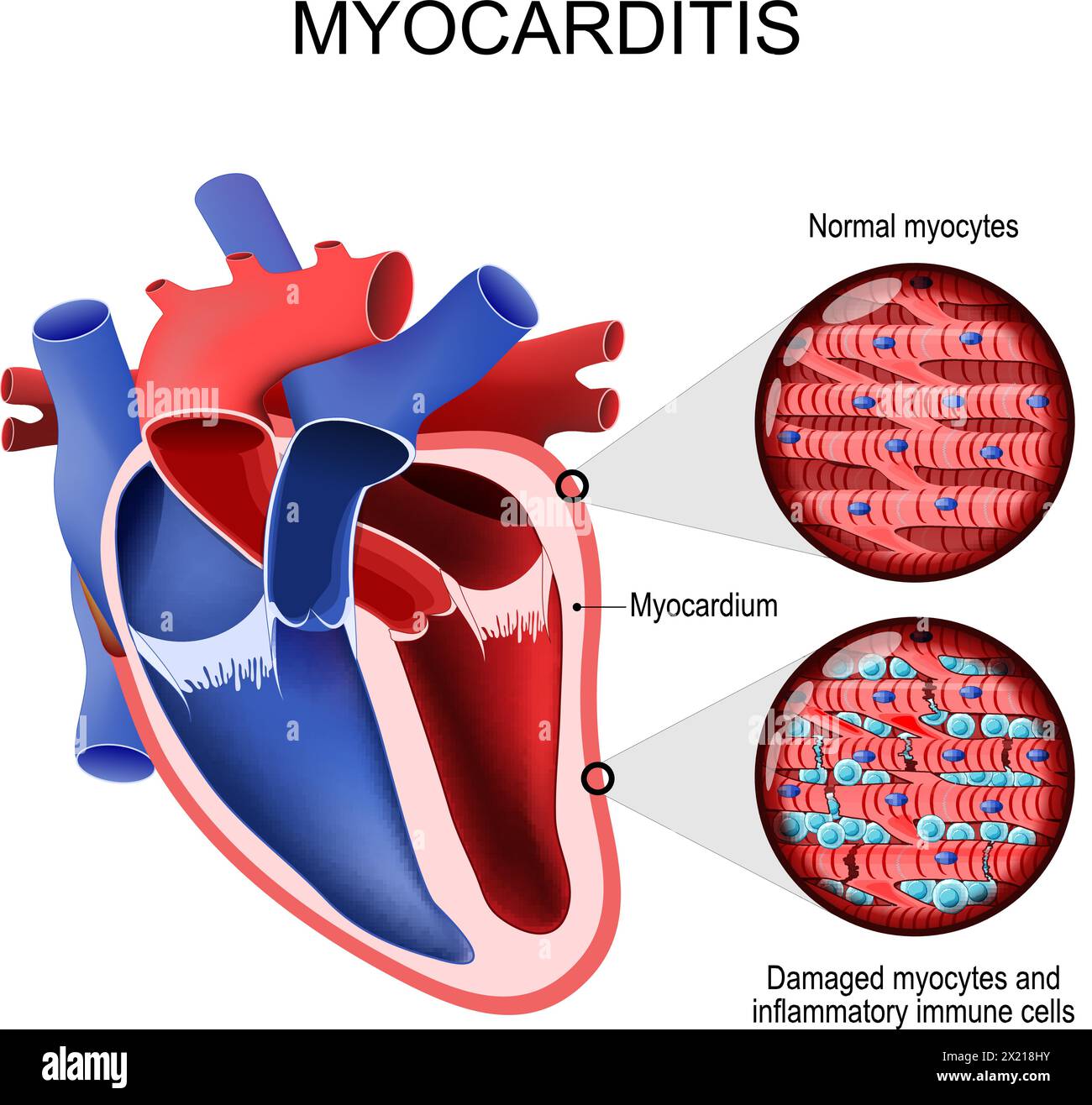 Myokarditis. Entzündliche Kardiomyopathie. Querschnitt eines menschlichen Herzens und Herzmuskels. Nahaufnahme normaler Myozyten, geschädigter Myozyten und Entzündungen Stock Vektor