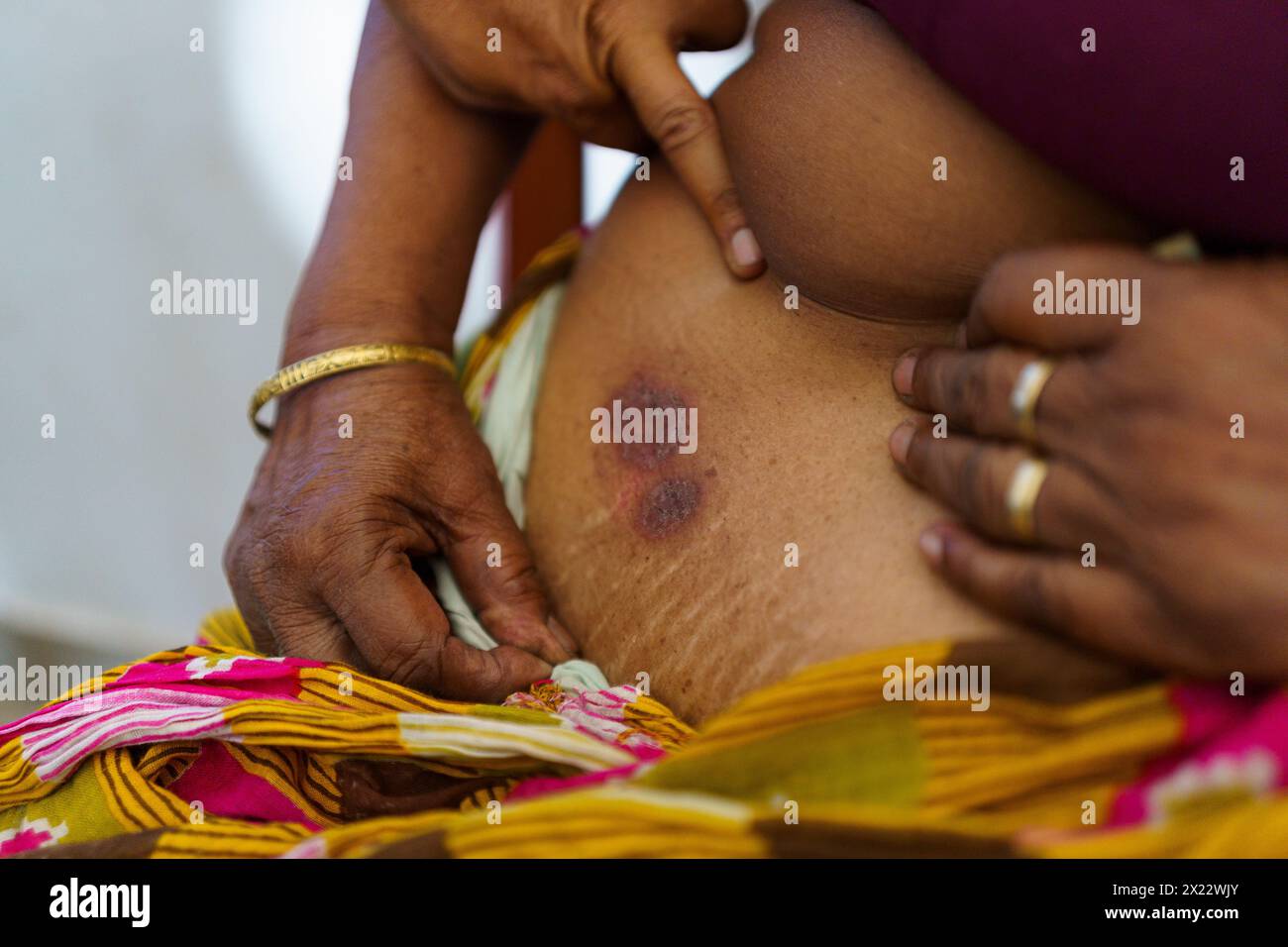Eine alte indianerin zeigt ein Ekzem auf ihrer Haut unter ihrem Sari in einer Klinik im ländlichen indien. Die Gesundheitsversorgung ist ein wichtiges Thema auf dem indischen Land Stockfoto