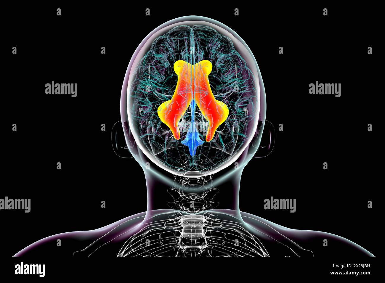 Vergrößerte laterale Ventrikel des Gehirns, Illustration Stockfoto