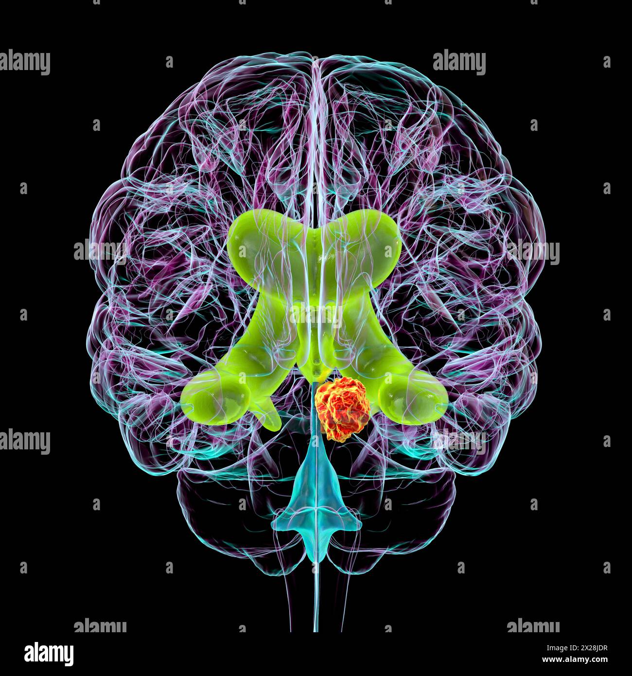 Hirntumor, der Hydrozephalus verursacht, Illustration Stockfoto