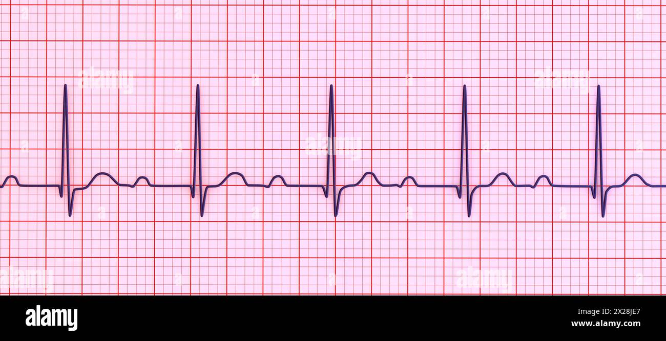 EKG mit AV-Block ersten Grades, Abbildung Stockfoto