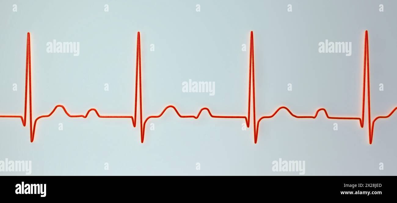 EKG mit AV-Block ersten Grades, Abbildung Stockfoto