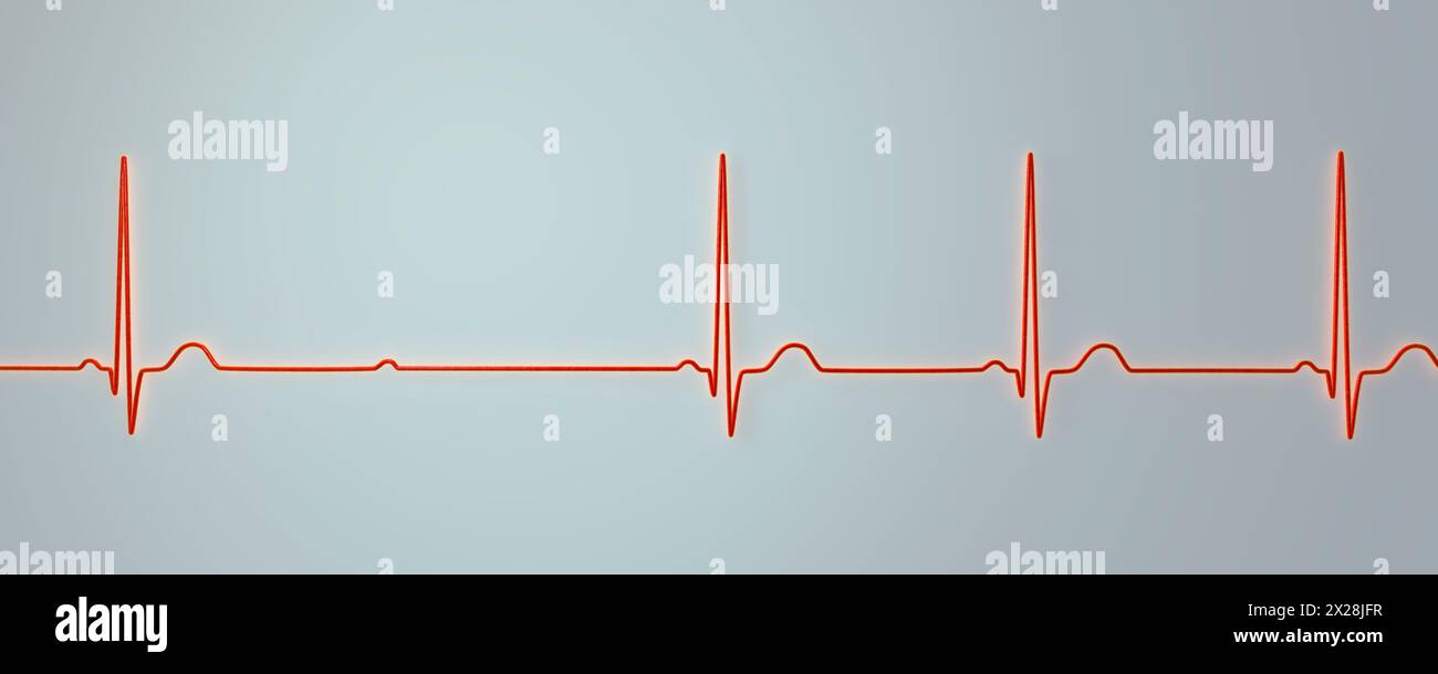 EKG mit Mobitz 2 AV-Block zweiten Grades, Abbildung Stockfoto