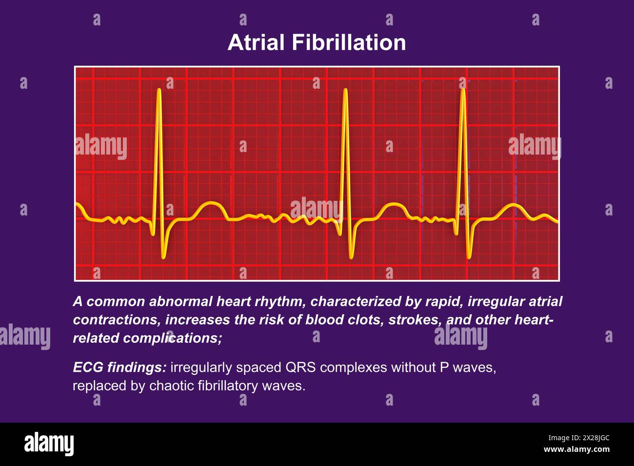 EKG bei Vorhofflimmern, Illustration Stockfoto