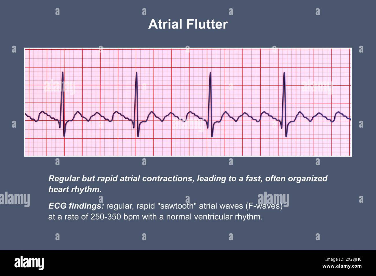 EKG bei Vorhofflattern, Illustration Stockfoto