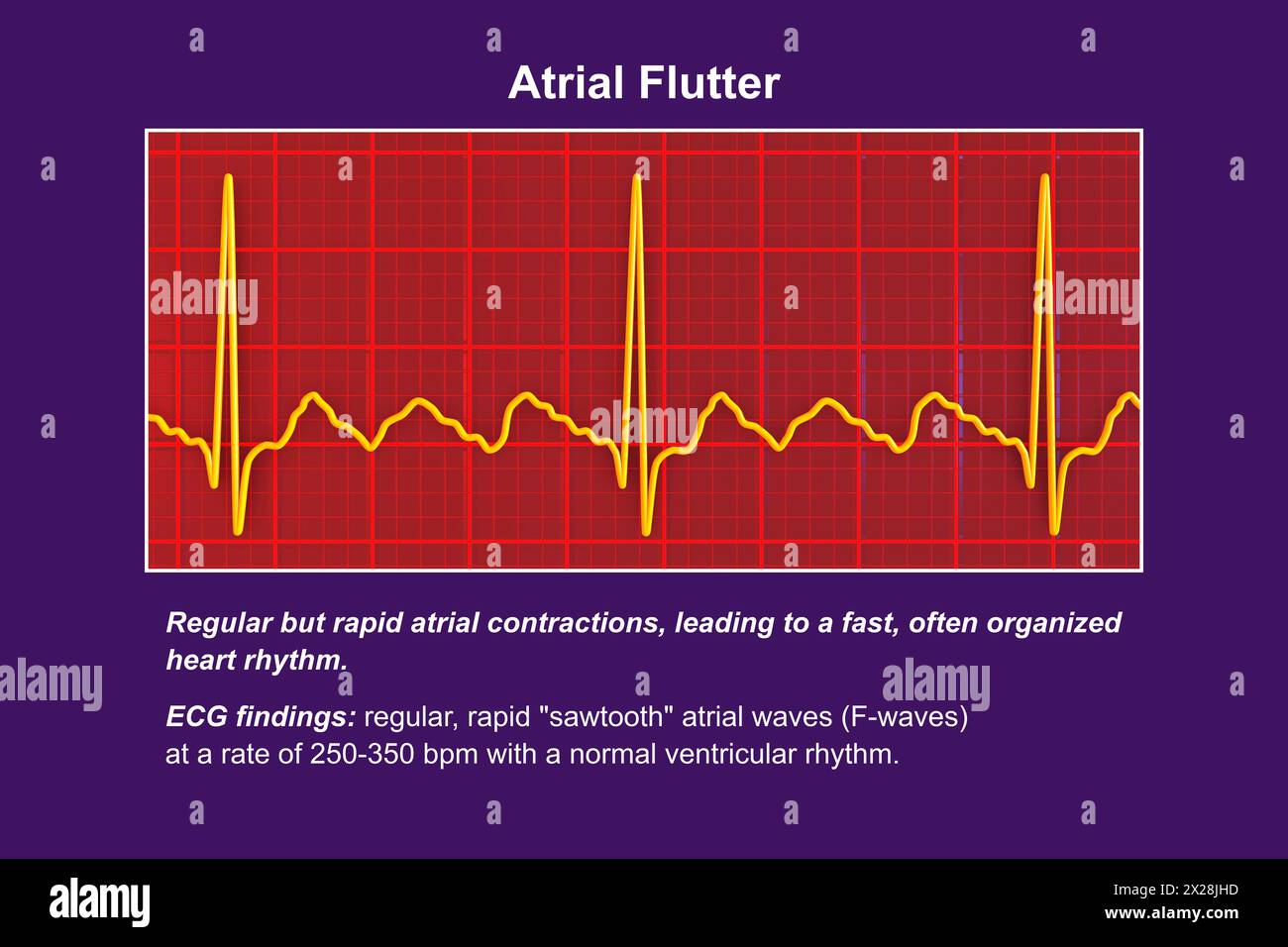 EKG bei Vorhofflattern, Illustration Stockfoto