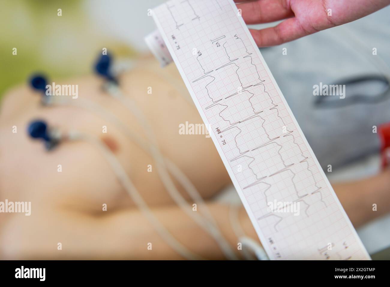 Ein Patient, der sich einem Elektrokardiogramm mit Elektroden an der Brust unterzieht, während ein medizinisches Fachpersonal die EKG-Anzeige untersucht. Stockfoto