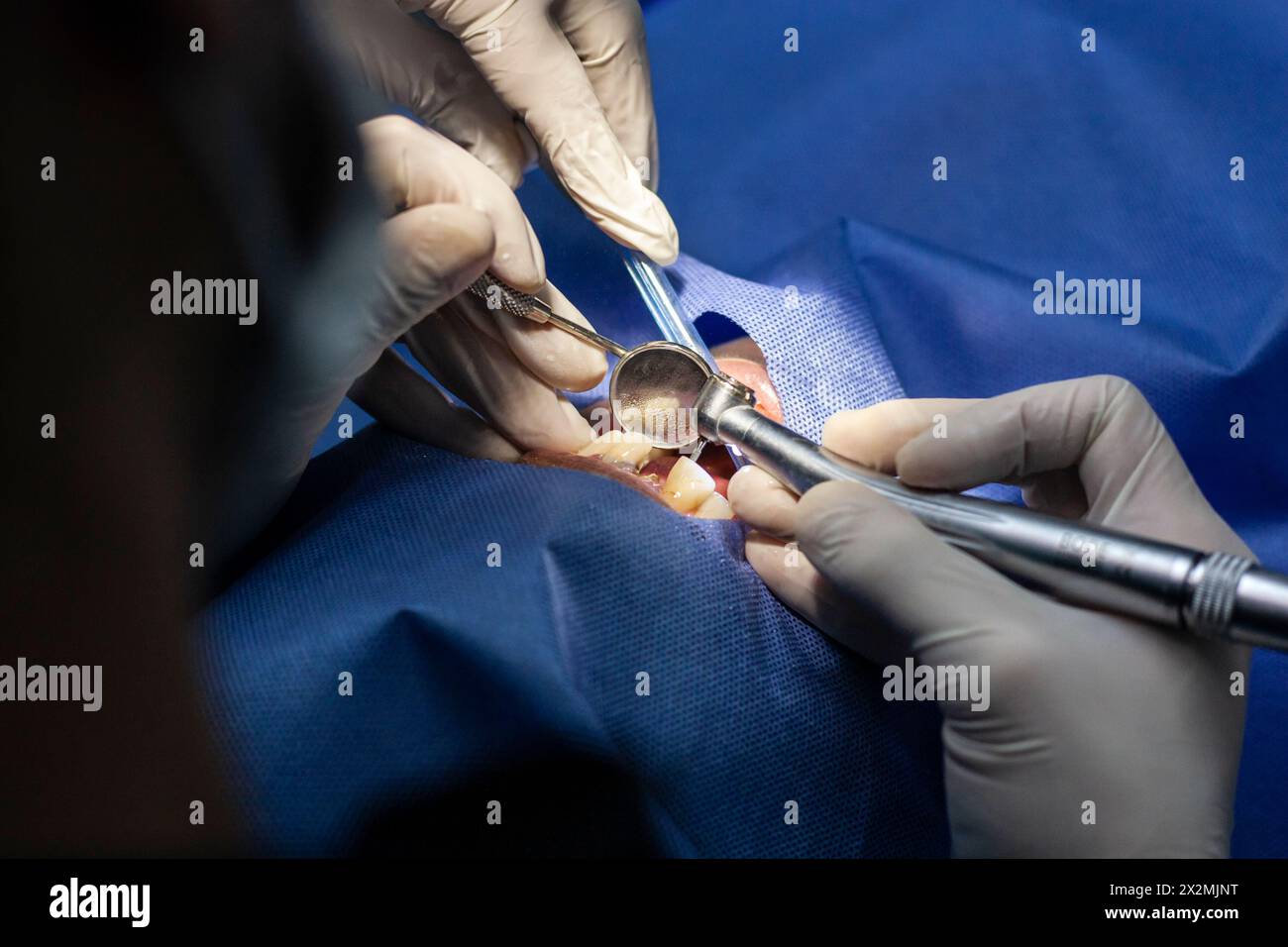 Zahnärztliche Spezialbehandlung bei Patienten mit Zahnersatz und Karies Stockfoto