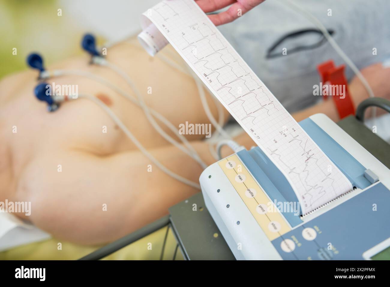 Ein Patient, der sich einem Elektrokardiogramm mit Elektroden an der Brust unterzieht, während ein medizinisches Fachpersonal die EKG-Anzeige untersucht. Stockfoto