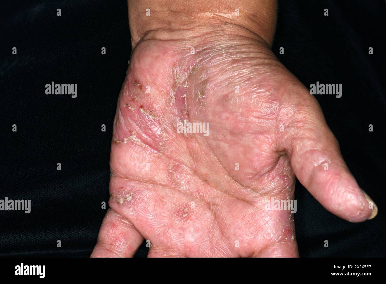 Ringelwurminfektion an der Hand einer hispanischen Patientin. Ringelflechte ist eine Pilzinfektion der Haut, die hoch ansteckend ist. Dies ist Tinea incognita, eine Form der Infektion, die fälschlicherweise mit Steroiden und nicht mit einem Antimykotikum behandelt wurde. Stockfoto