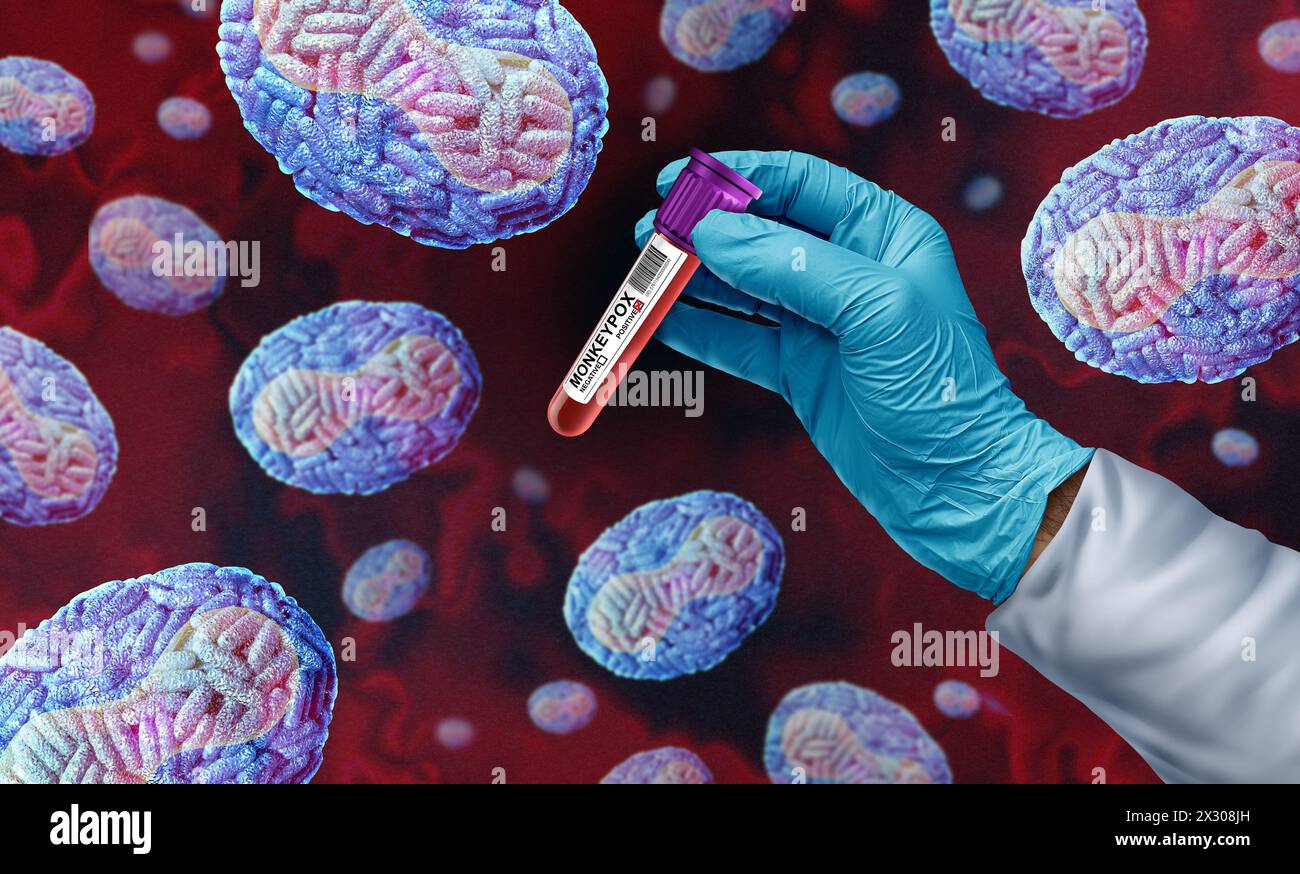 Affenpocken oder Mpox Virus Ausbruch Krankheit Pandemie als Arzt oder Wissenschaftler mit infiziertem Blut mit Viruspathogen infiziert Menschen als Virologie Stockfoto