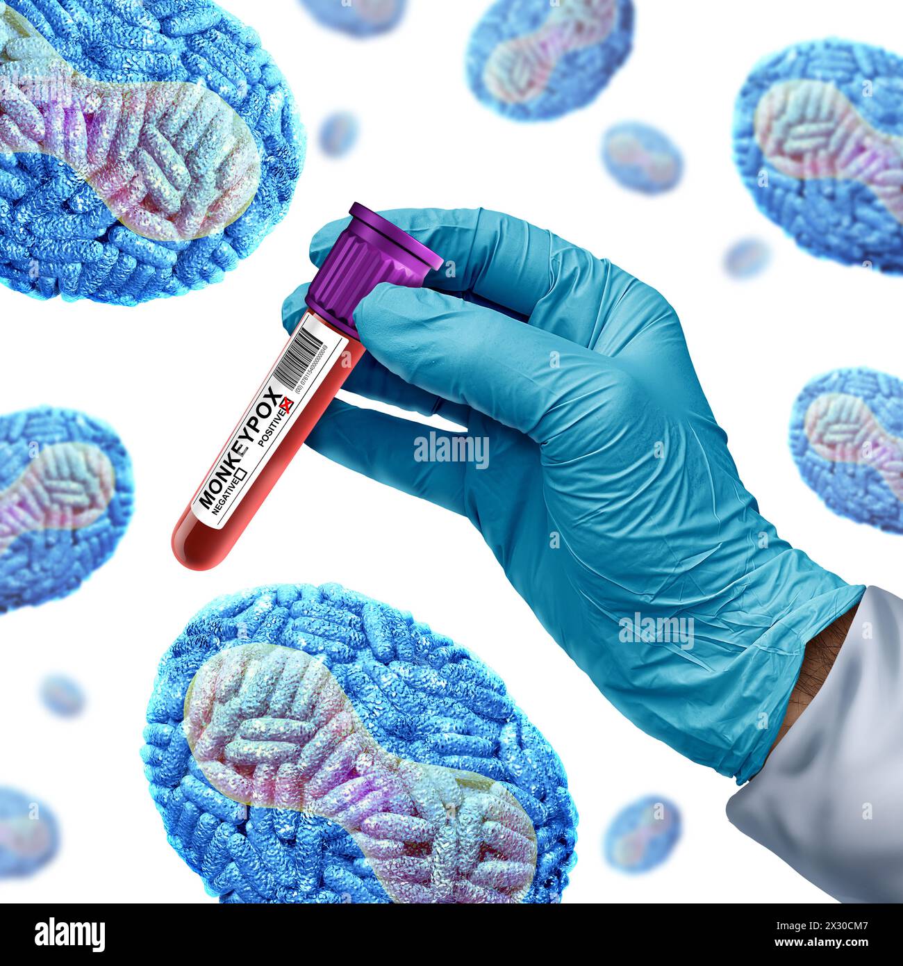 Affenpocken oder Affenpocken Virus Ausbruch Krankheit Pandemie als Arzt oder Wissenschaftler mit infiziertem Blut mit viralem Erreger infiziert Menschen Stockfoto