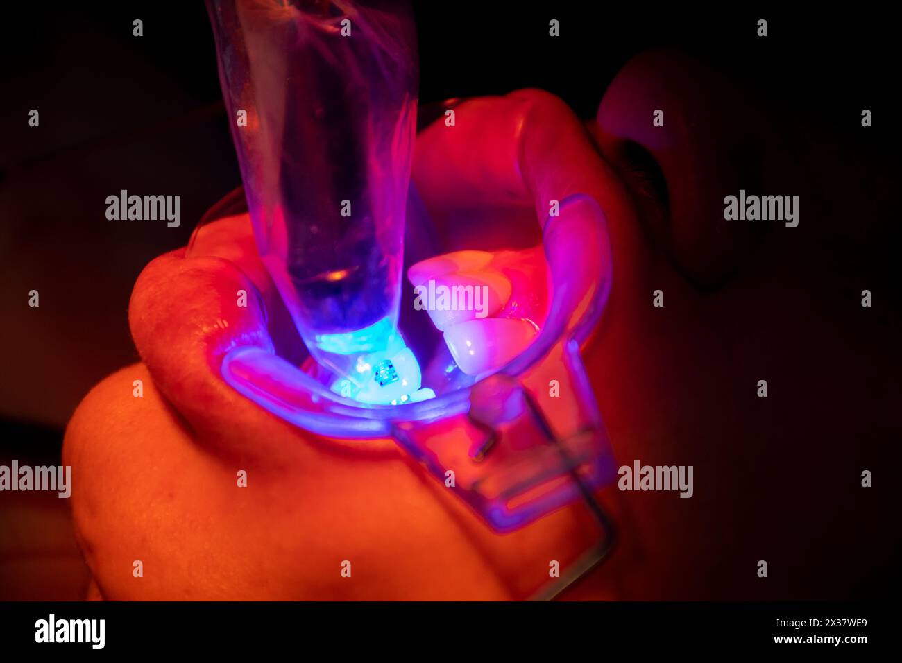 UV-Licht während zahnärztlicher Eingriffe Stockfoto
