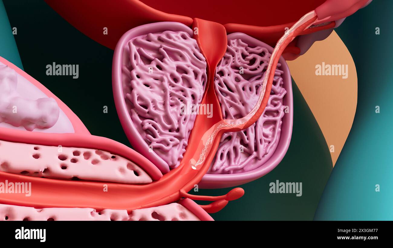 Illustration von Ejakulat mit Spermien (Spermien, weiß) und Samenflüssigkeit, die durch die Prostata (rosa) bewegt wird. Während der Ejakulation wandern Spermatozoen von den Hoden (Hoden) in die Harnröhre (Hohlrohr im Penis), wobei Sekrete aus verschiedenen Organen für Motilität und Ernährung hinzugefügt werden, um Samen zu bilden. Eines dieser Organe ist die Prostata, die Prostataflüssigkeit absondert. Die Kontraktion der Prostata-Muskeln, die durch den sich verengenden Schlauch gezeigt wird, verhindert auch, dass sich Urin mit dem Sperma vermischt. Stockfoto