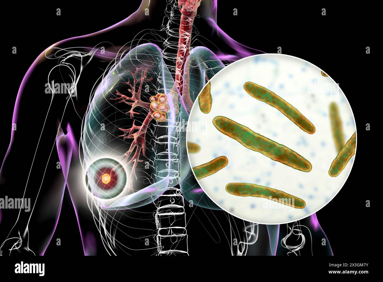 Illustration der primären Lungentuberkulose mit dem Ranke-Komplex, Hervorhebung von Lungenläsionen und mediastinaler Lymphadenitis mit Nahaufnahme von Mycobacterium tuberculosis-Bakterien. Stockfoto