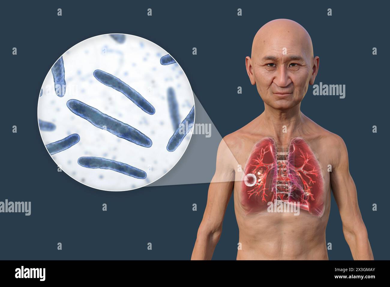 Illustration eines Mannes mit Lungen mit kavernöser Tuberkulose und Nahaufnahme von Mycobacterium tuberculosis-Bakterien. Stockfoto