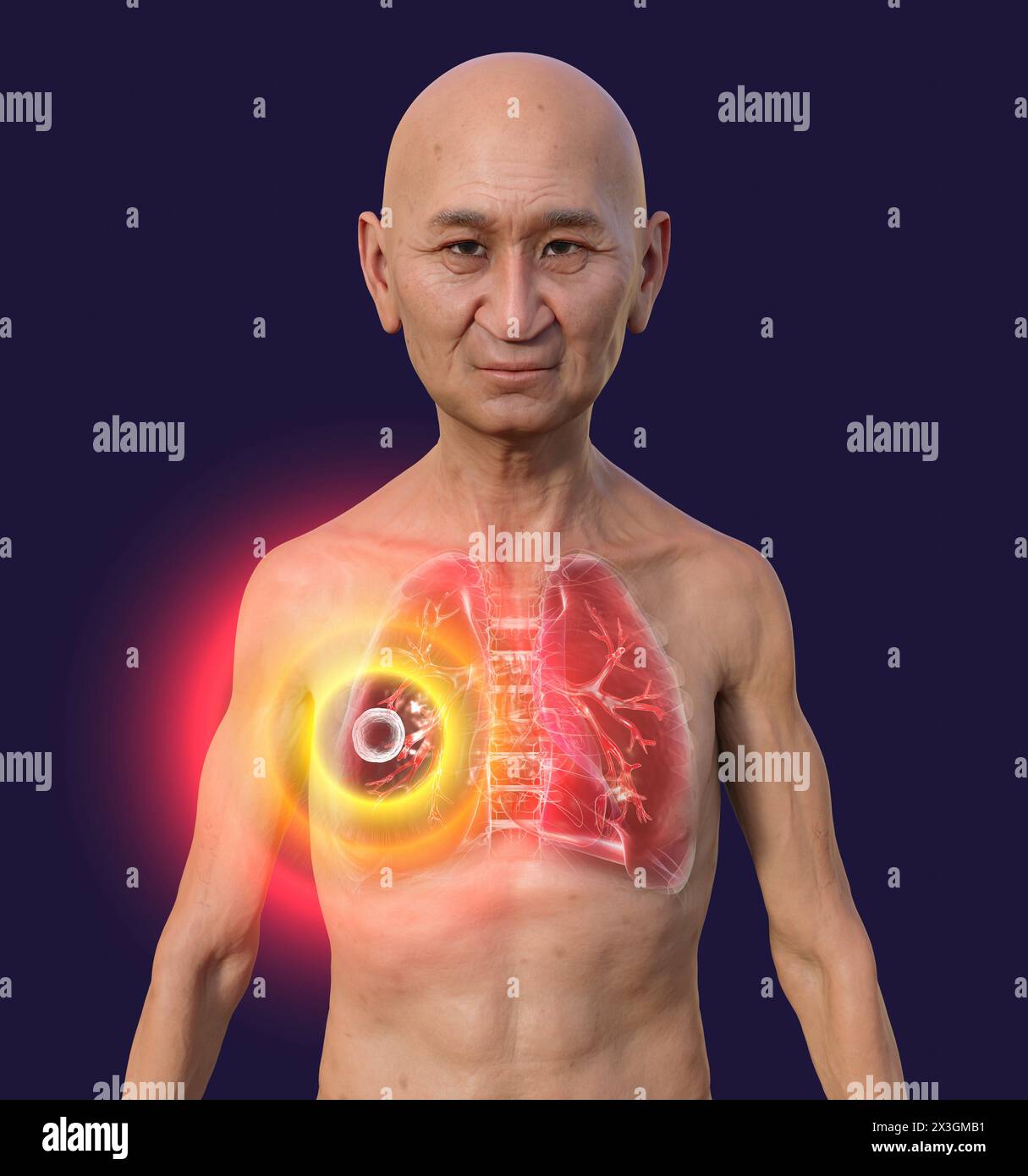 Illustration eines Mannes mit Lungen von kavernöser Tuberkulose. Stockfoto