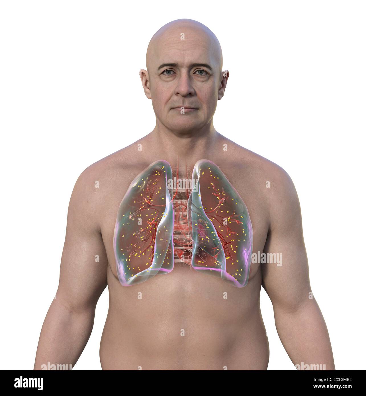 Abbildung eines Mannes mit Lungenadiaspiromykose, einer durch den Pilz Emmonsia spp. Verursachten Atemwegsinfektion, die durch das Vorhandensein von vergrößerten verkapselten Pilzsporen im Lungengewebe gekennzeichnet ist. Stockfoto