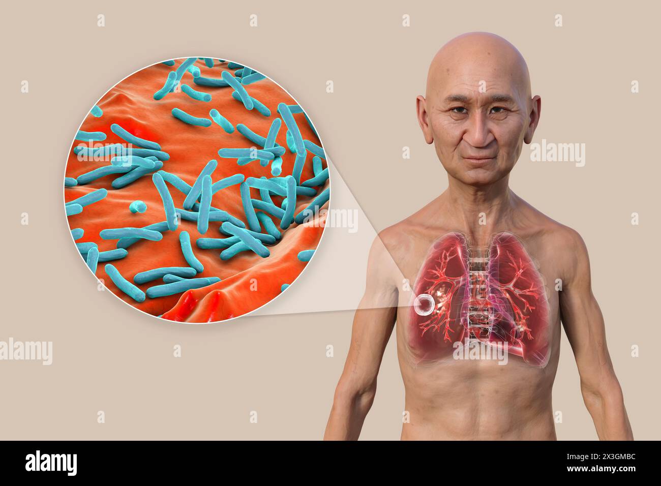 Illustration eines Mannes mit Lungen mit kavernöser Tuberkulose und Nahaufnahme von Mycobacterium tuberculosis-Bakterien. Stockfoto