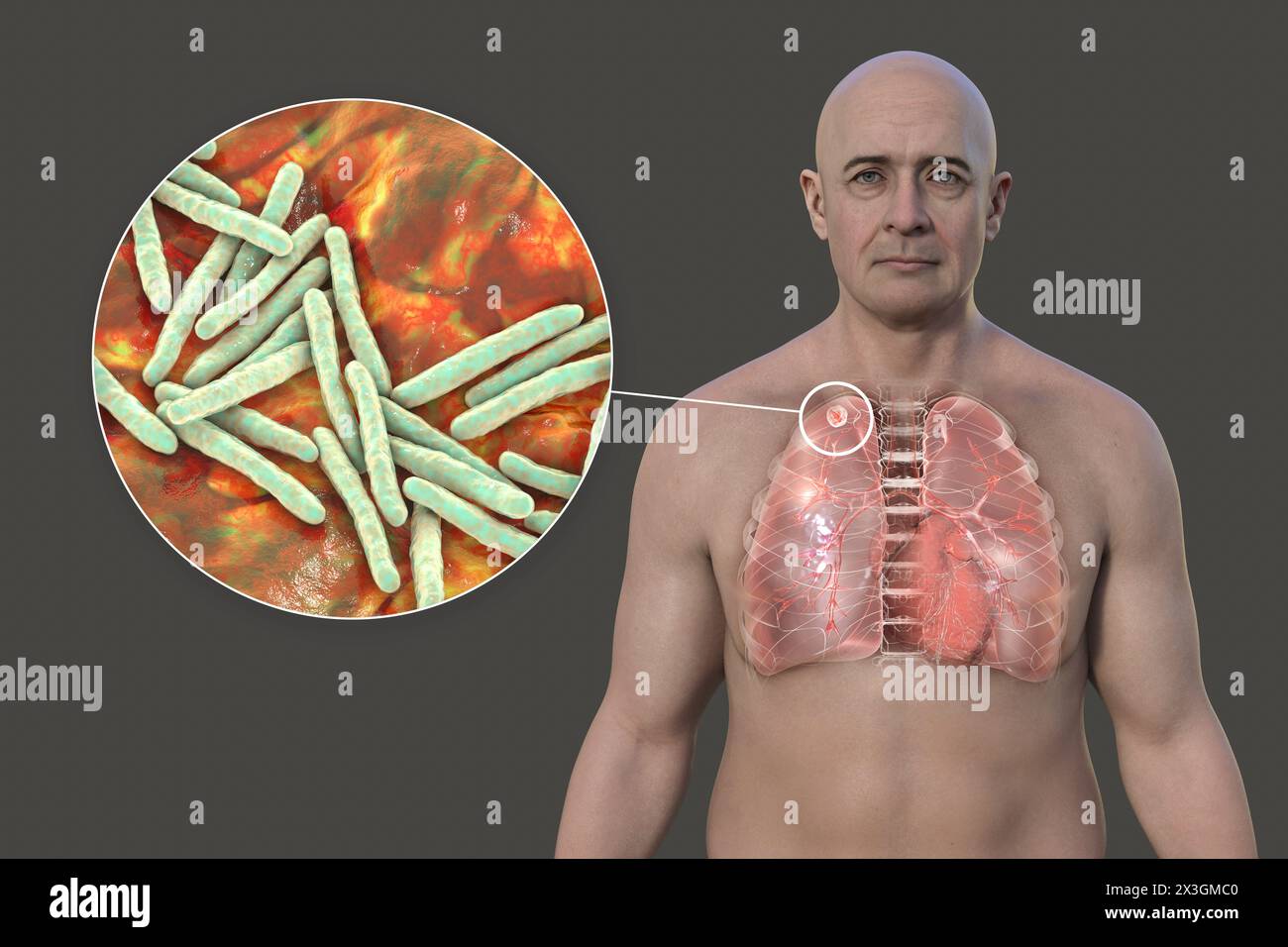 Illustration eines Mannes mit Lungen mit sekundärer Tuberkulose und Nahaufnahme von Mycobacterium tuberculosis-Bakterien. Stockfoto