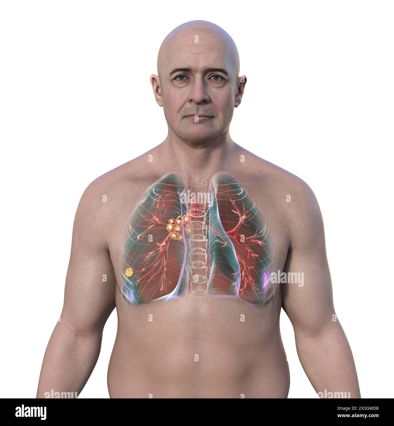 Illustration eines Mannes mit primärer Lungentuberkulose, Aufdeckung des Ranke-Komplexes und Hervorhebung von Lungenläsionen und mediastinaler Lymphadenitis. Stockfoto