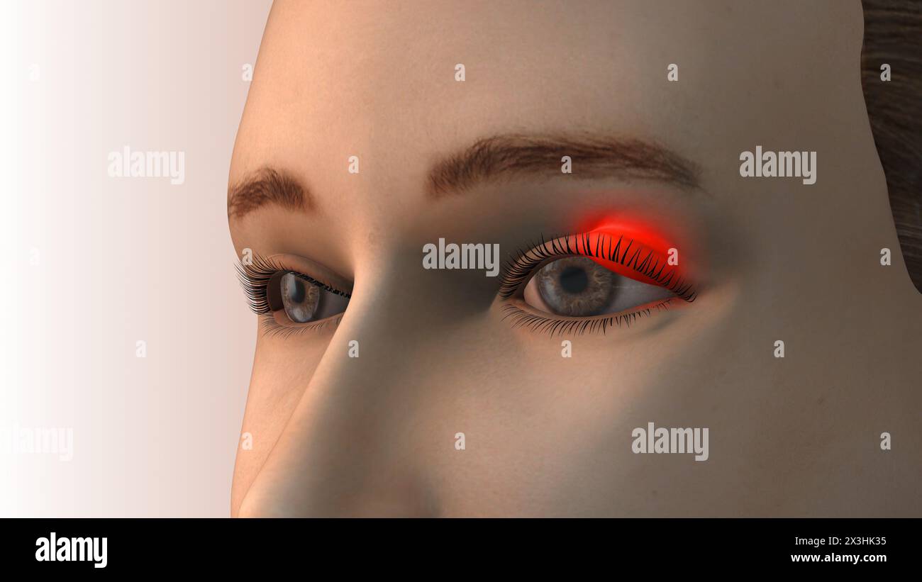 Nahaufnahme eines geschwollenen Augenlids durch eine bakterielle Infektion Stockfoto