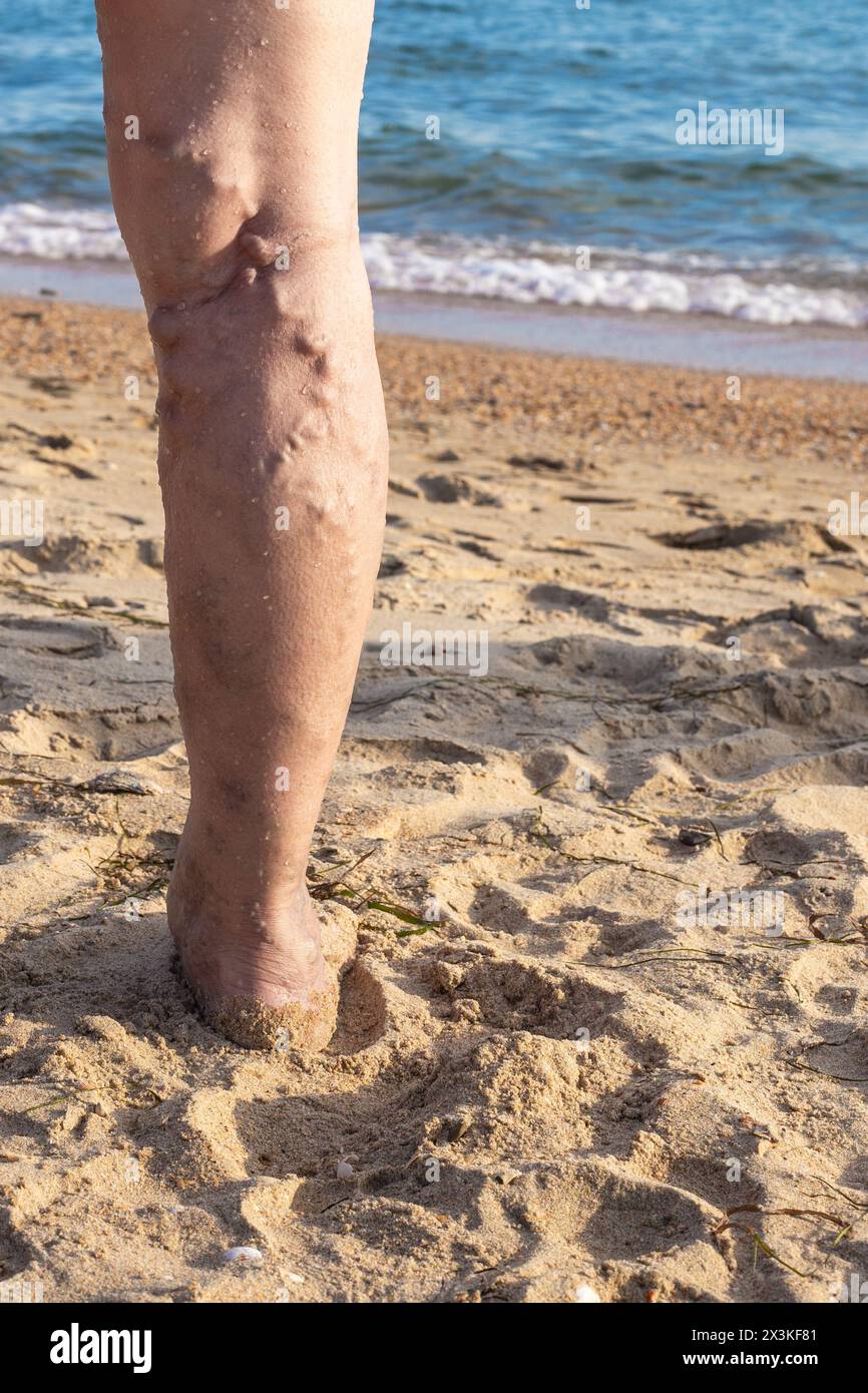 Bein einer älteren Frau mit Venenproblemen. Thrombophlebitis der Gefässe der unteren Extremitäten. Stockfoto