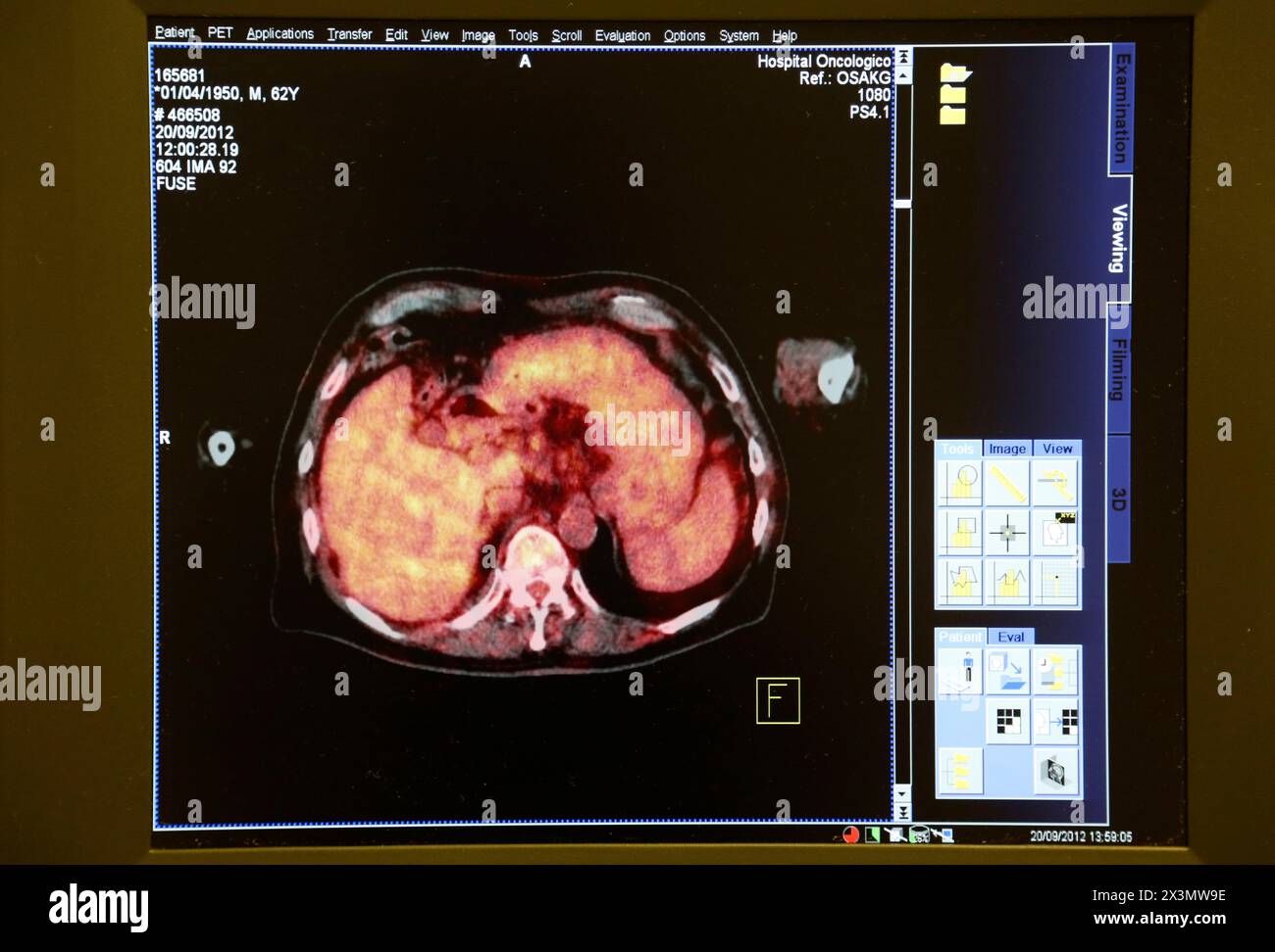 PET-CT Siemens Biograph Image, kombinierte Apparatur für Positronen-Emissions-Tomographie PET und Röntgen-Computertomographie CT, Nuklearmedizin, Onkologikoa Stockfoto