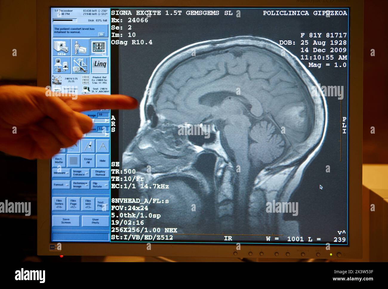 Hirntumor, MRT (Magnetresonanztomographie), medizinische Bildgebung zur Diagnose. Krankenhaus Policlinica Gipuzkoa, San Sebastian, Donostia, Euskadi, Spanien Stockfoto