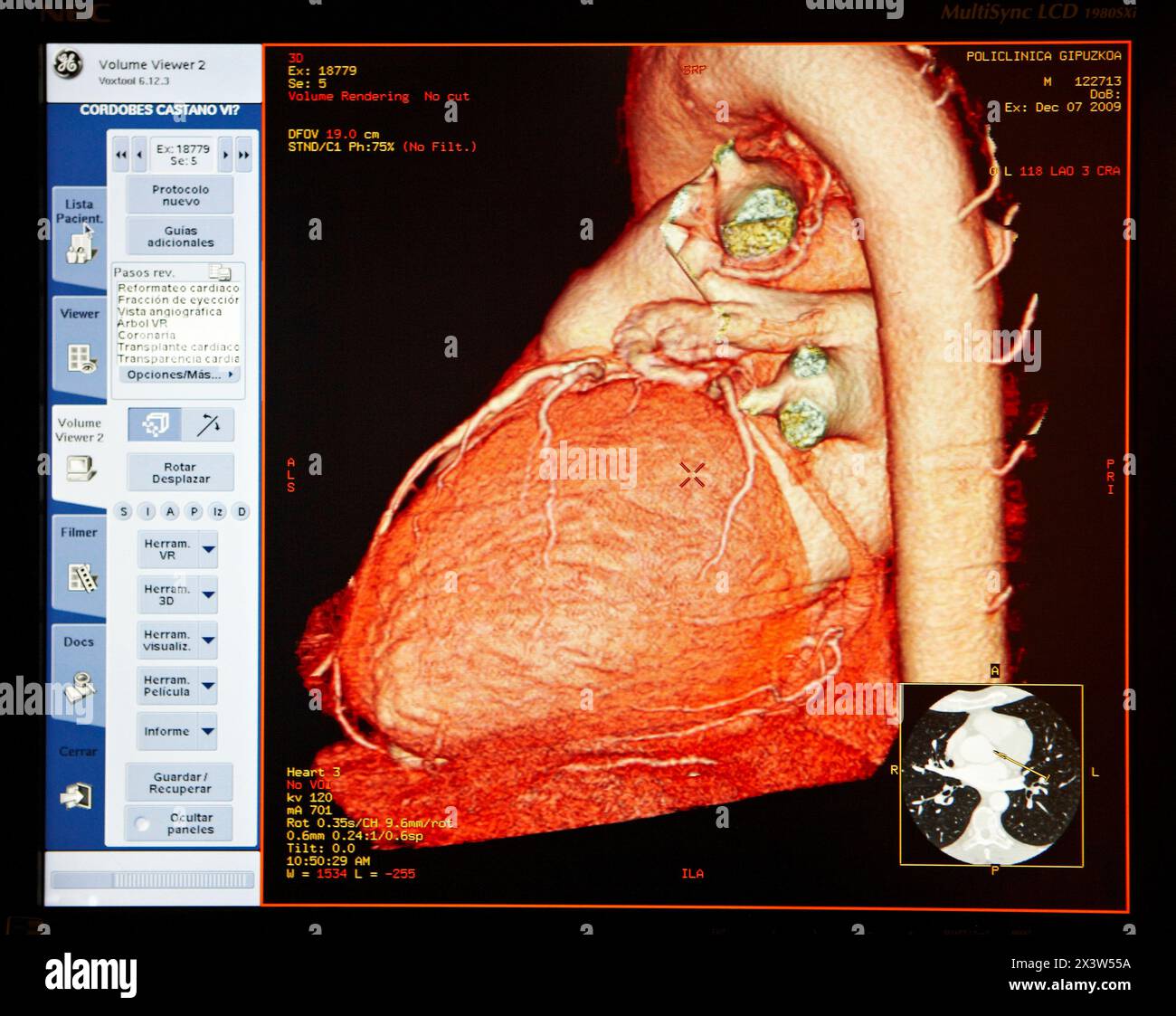 Herz, Aortenbogen und Koronararterien, CAT-Scan (Computer Axial Tomography), Radiologie, medizinische Bildgebung zur Diagnose. Krankenhaus Policlini Stockfoto