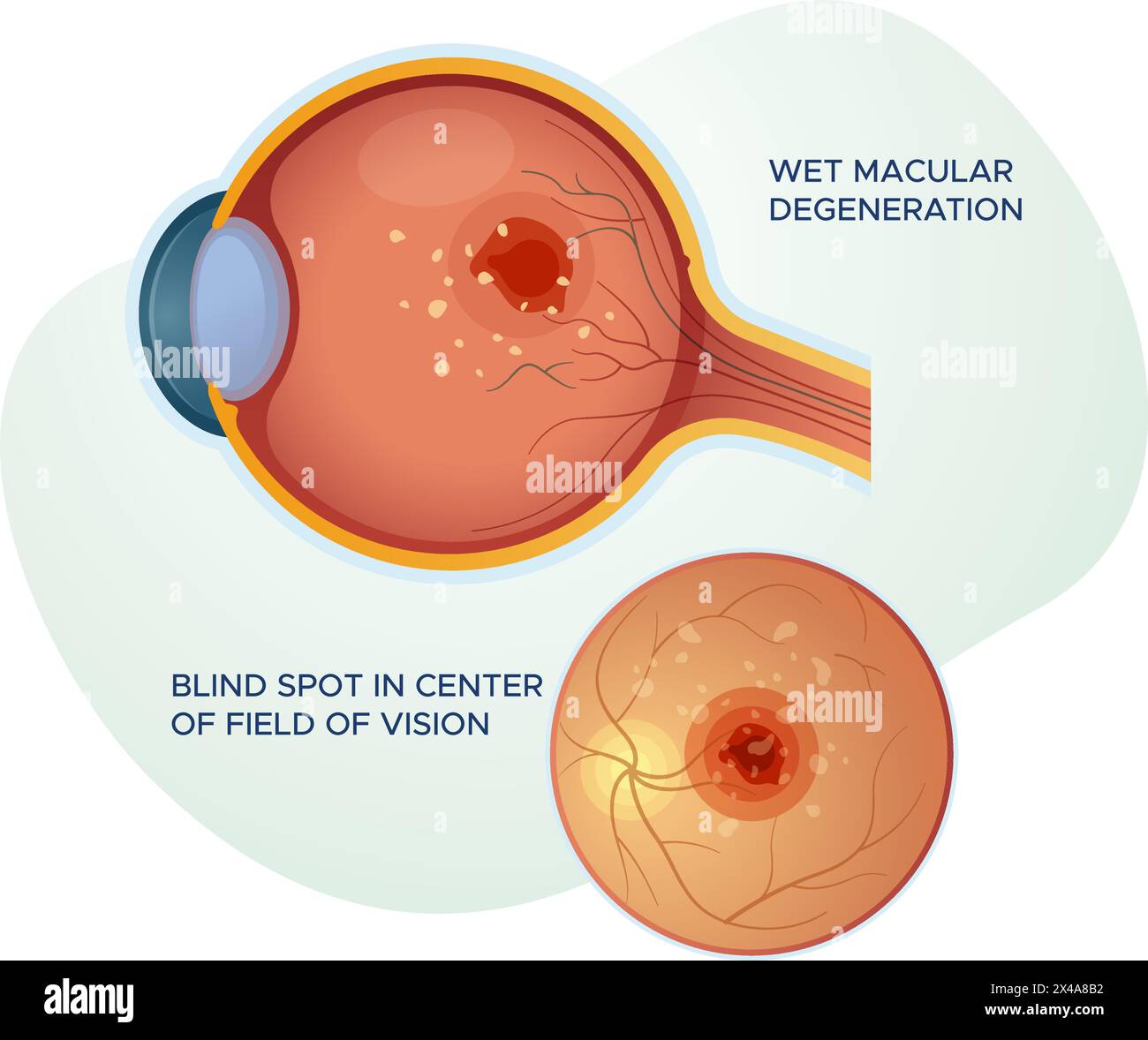 Feuchte Makuladegeneration – Abbildung als EPS 10-Datei Stock Vektor