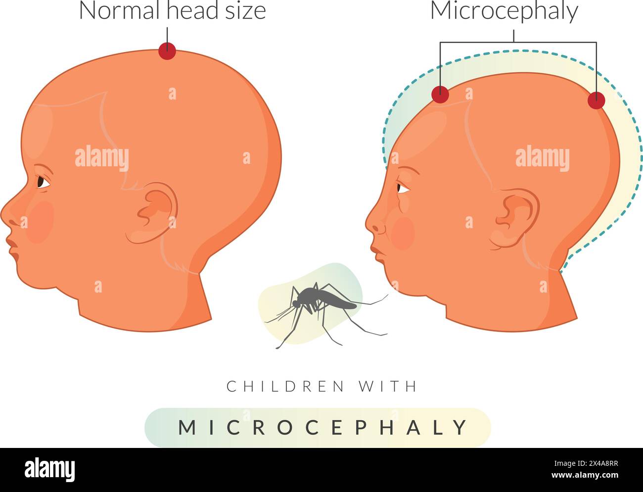 Kinder mit Mikrozephalie - Zika-Virus - Stock-Illustration als EPS 10 Datei Stock Vektor