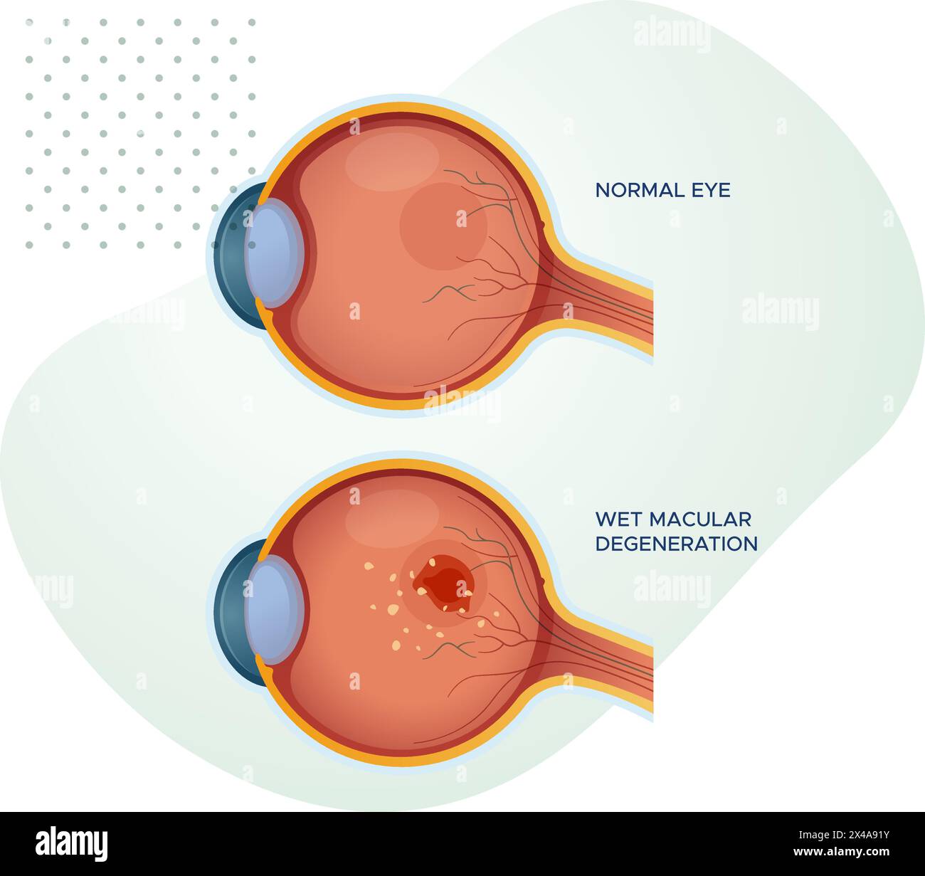 Gesunde Augen vs nasse Makuladegeneration - Stock-Illustration als EPS 10 Datei Stock Vektor