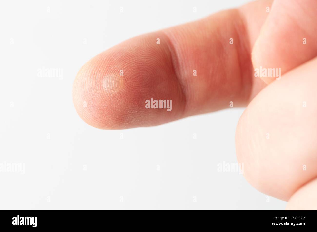 Bestrahlungsblase auf Finger-Makronahtansicht isoliert Stockfoto