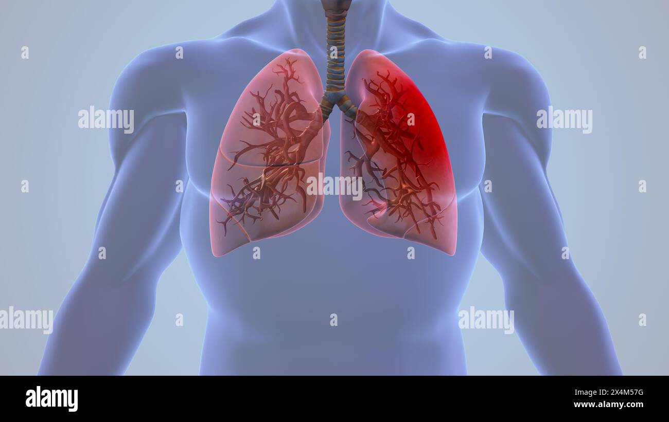 Pleuritis-Lungenentzündungsschmerz Beim Menschen Stockfoto