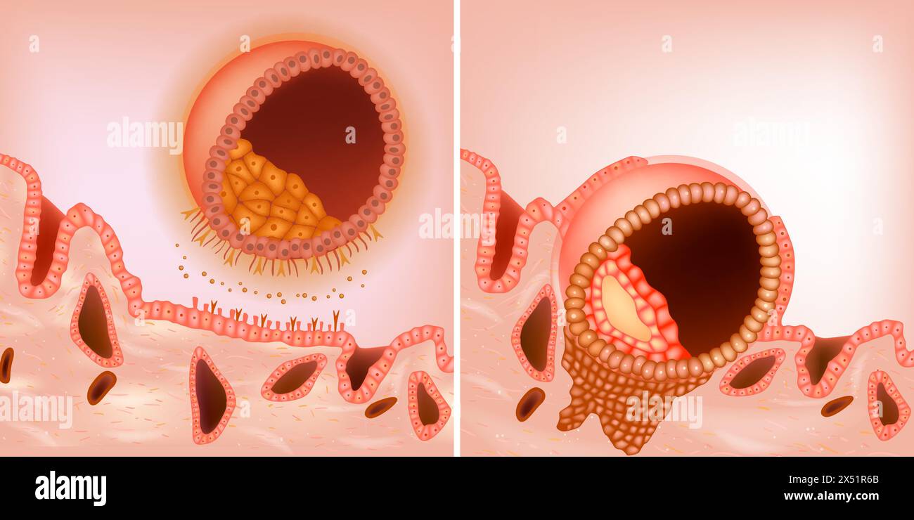 Der Prozess während der Embryoimplantation. Die Blastozyste implantiert in das mütterliche Endometrium. Blastozystenappposition und Adhäsion Stock Vektor