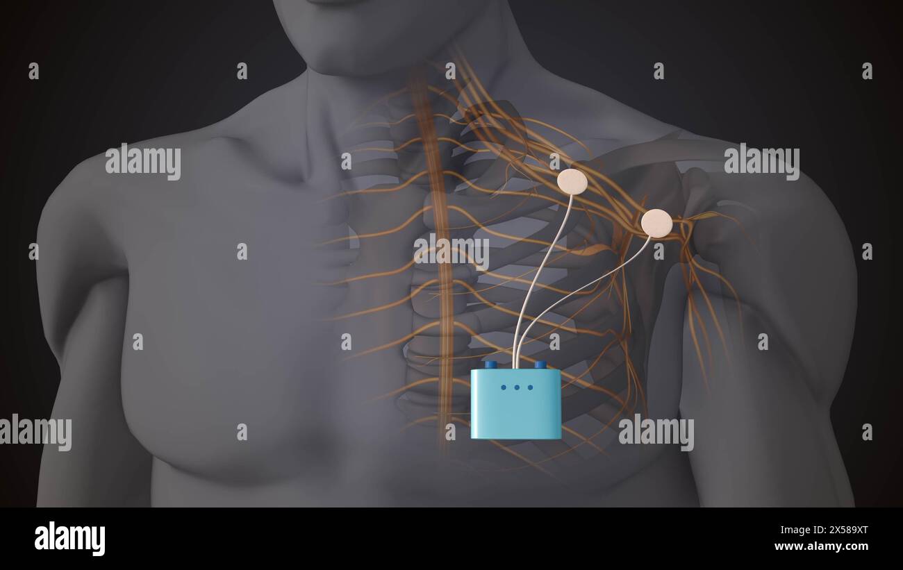 Therapie mit peripherer Nervenstimulation im Schulterbereich Stockfoto