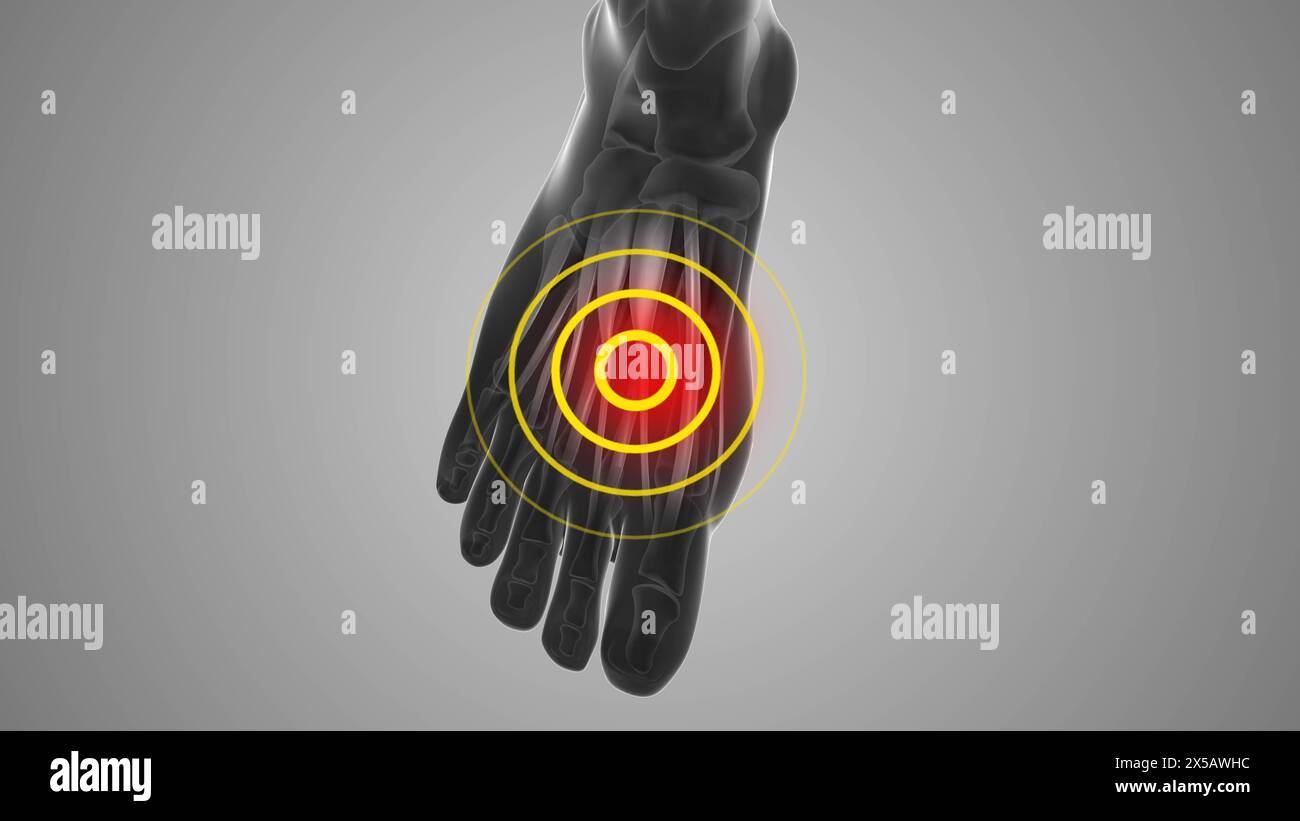 Schmerzauslösende Streckensehnenbeschwerden digitorum longus Stockfoto