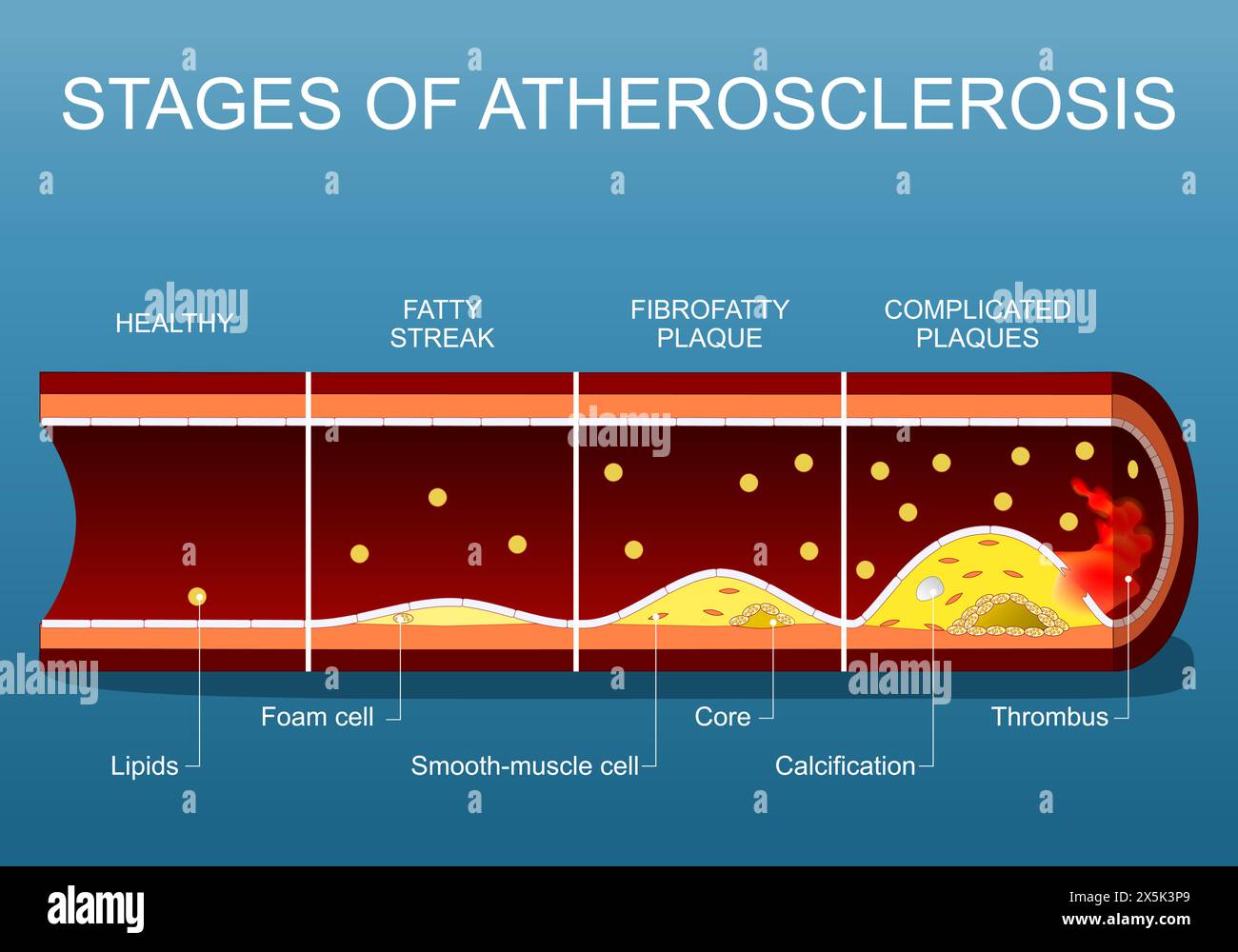 Stadien der Atherosklerose von Lipiden in Blutfluss und Fettstreifenablagerung im Endothel, zur fibrofettigen Plaquebildung, Plaquebildung, Calci Stock Vektor