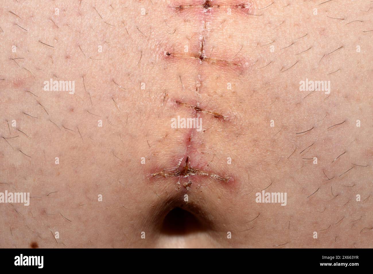 Heilende chirurgische Naht nach Entfernung einer Nabelhernie am Bauch eines Mannes, Nahaufnahme. Stockfoto