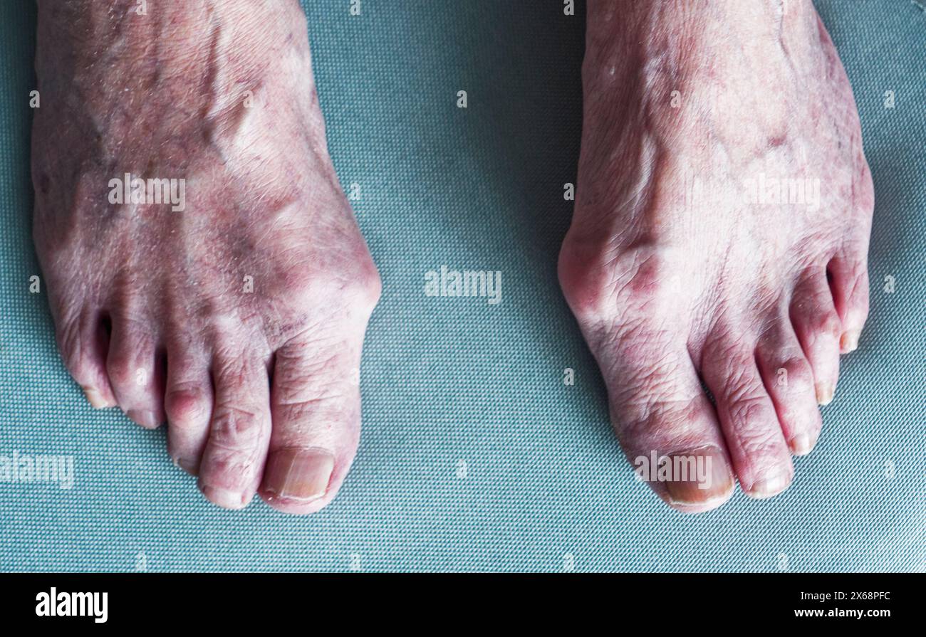 Ballenballen, Hallux valgus, auf den Füßen einer älteren Frau. Stockfoto